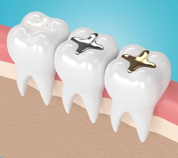 Knoxville Composite Fillings