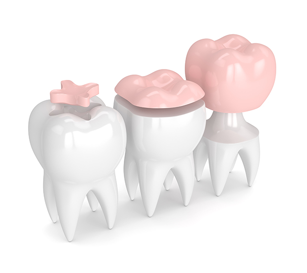 Knoxville Dental Inlays and Onlays