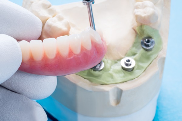 Why Choose Implant Supported Dentures?