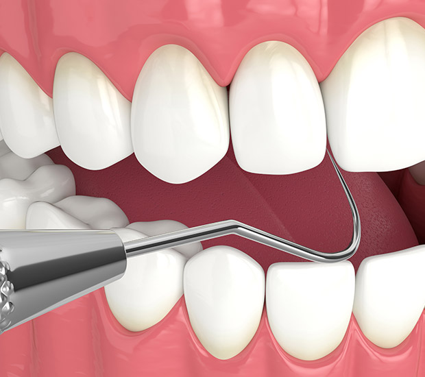 Knoxville Interactive Periodontal Probing